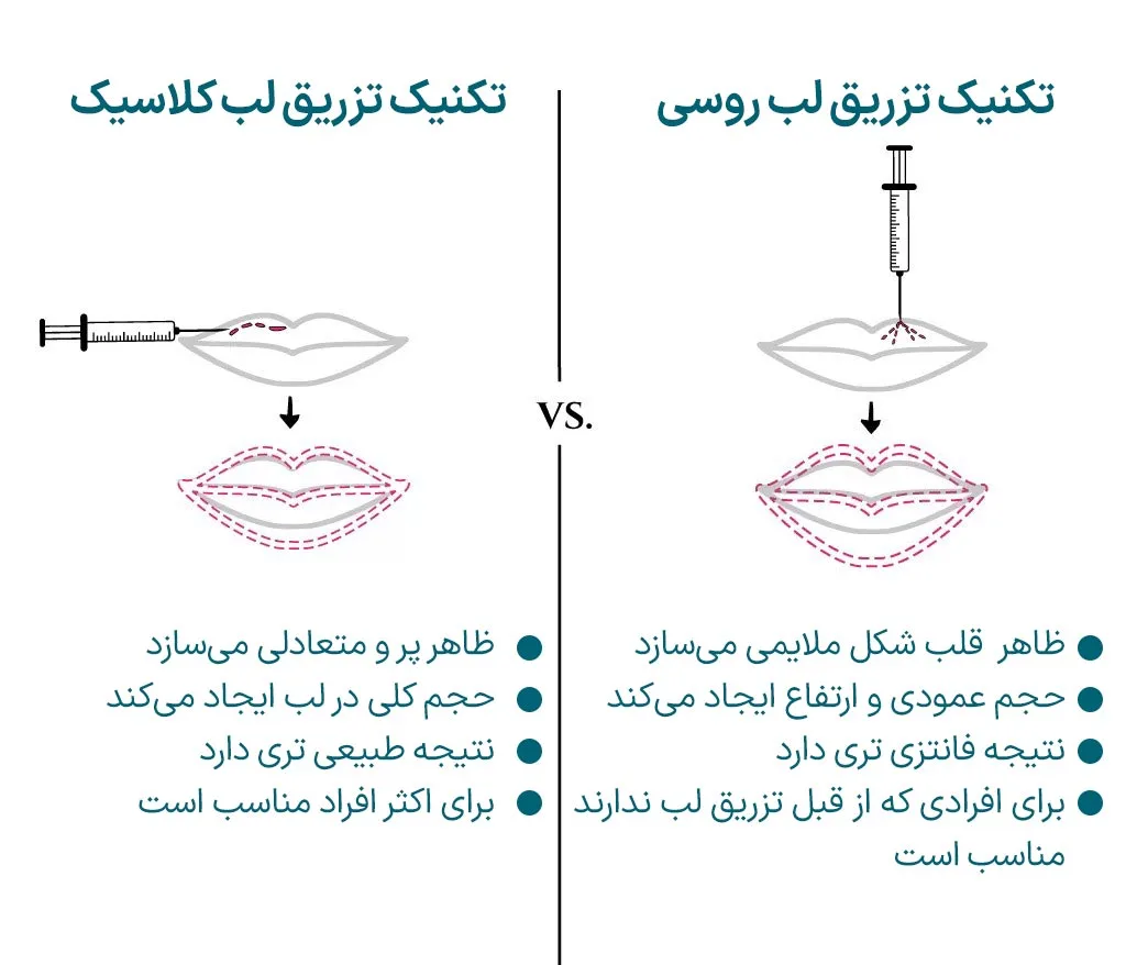 تفاوت تزریق لبی کلاسیک و روسی