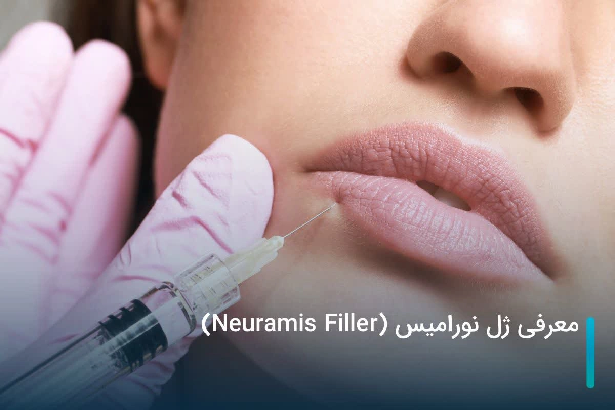 معرفی ژل نورامیس (Neuramis Filler) + نکات مهم