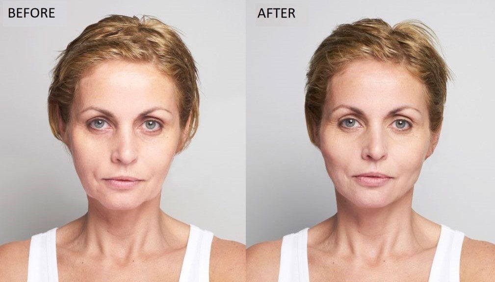 facial botox