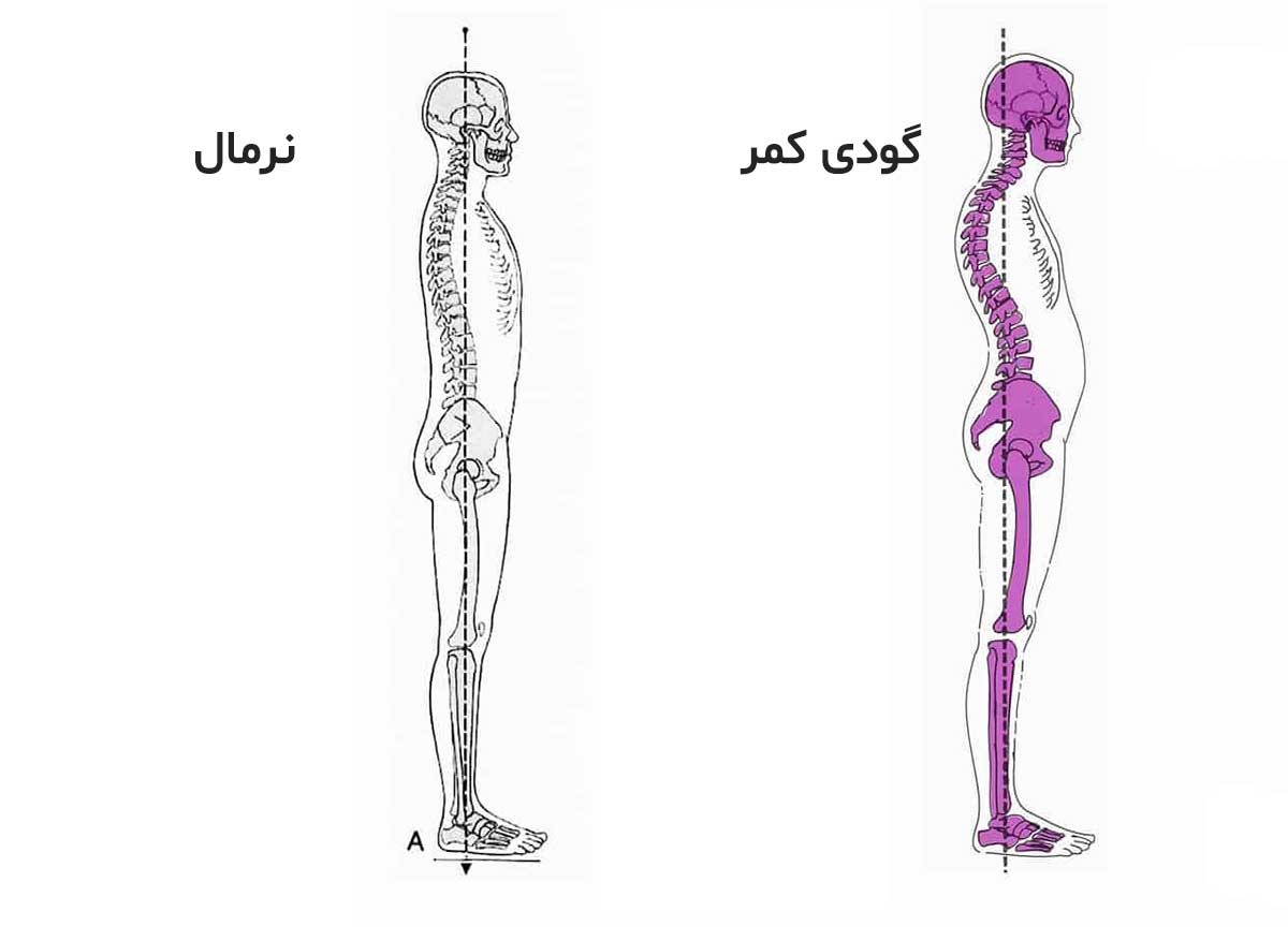lordosis 1