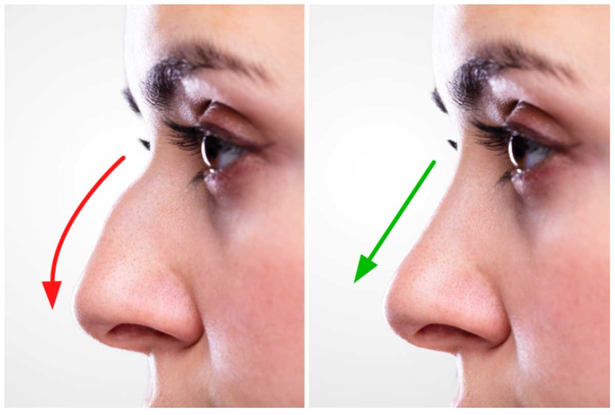talking after rhinoplasty
