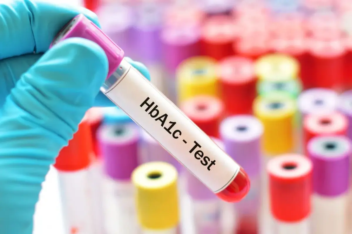 نکات مهم آزمایش قند خون A1c