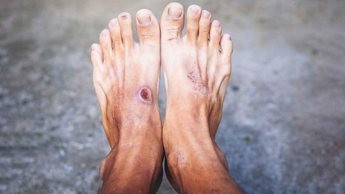 نحوه شستشو و پانسمان زخم دیابتی (بررسی با جزئیات)