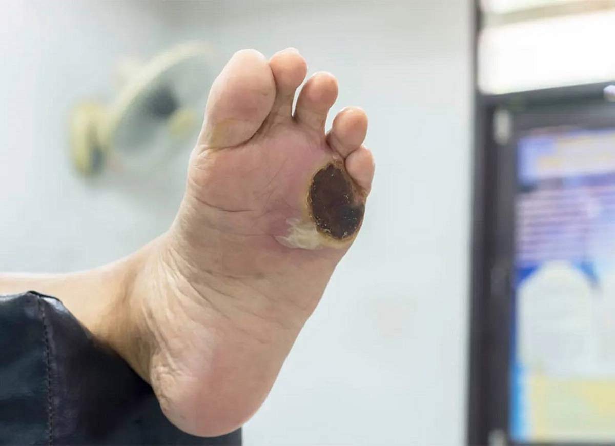 جلوگیری از ایجاد زخم دیابتی