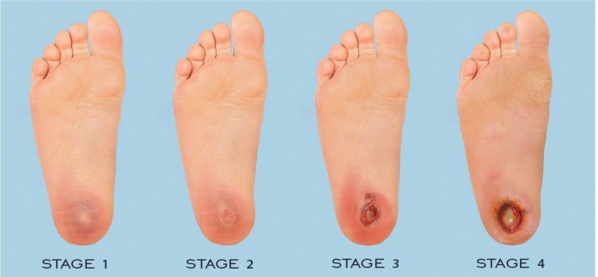 مراحل پیشرفت زخم دیابتی