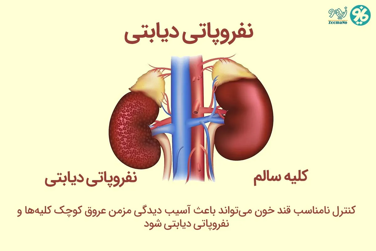 نفروپاتی دیابتی چگونه به وجود می آید