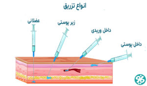تزریق عضلانی