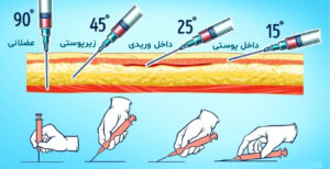 تزریق عضلانی