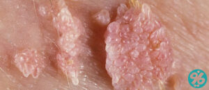 HPV در زنان