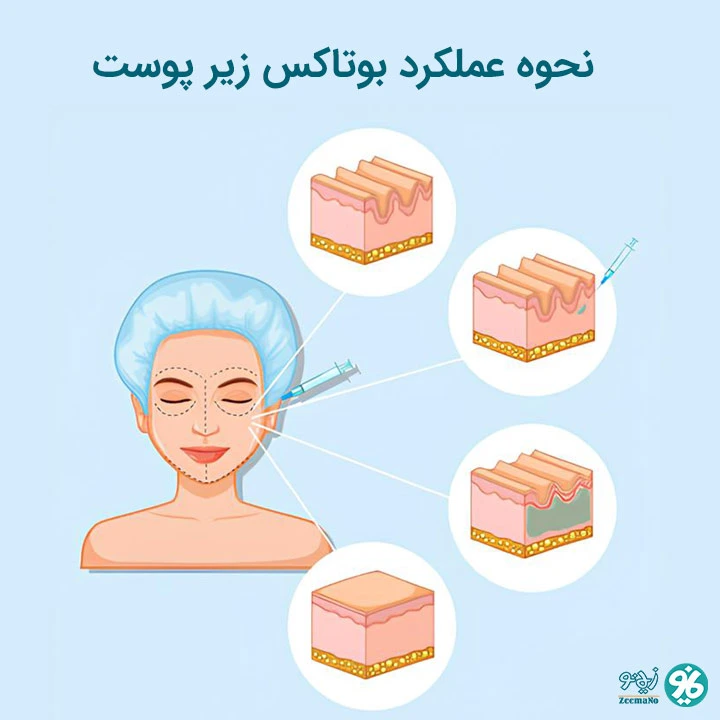نحوه عملکرد بوتاکس